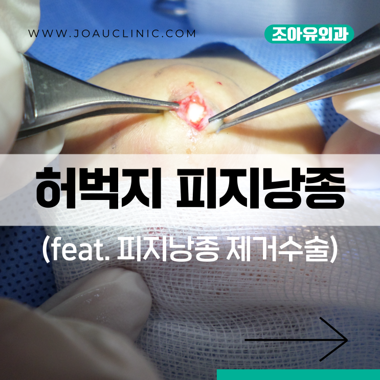 수원 허벅지 피지낭종 제거병원 - 다리에 혹 멍울이 있어요. : 네이버 블로그