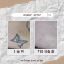 대형 문신제거 타투제거 전문 이레이저타투 eraser.tattoo