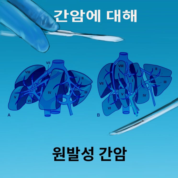 간암에 대해 (원발성 간암, 간세포성간암) : 네이버 블로그