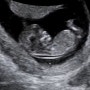 임신 초기 10주차 11주차 초음파 배크기 증상 태아 팔다리
