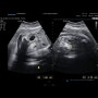 [ 임신32주 ] 진주참조은산부인과 / 태아콩팥크기변화 / 태아수신증