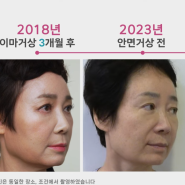 [다시, 청춘 프로젝트]60대 안면거상, 목거상 3개월 경과 후기