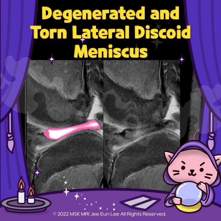 (Fig 1-C.08) Degenerated and torn lateral discoid meniscus : 네이버 블로그