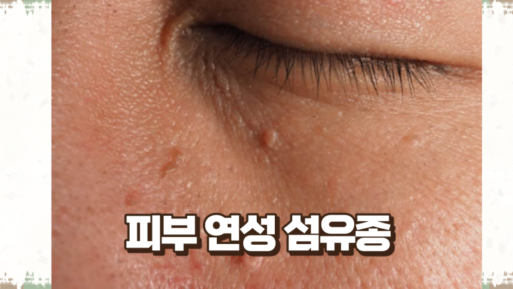 피부에 오돌토돌! 겨드랑이, 눈, 목 쥐젖 원인, 제거 방법 : 네이버 블로그