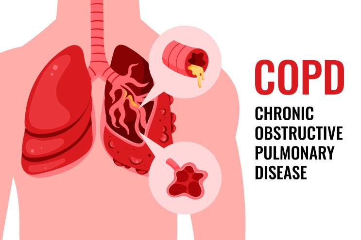 만성폐쇄성폐질환(COPD) 전 세계 사망 3위, 보은병원 디지털 폐기능검사기(The spirokit) 도입 : 네이버 블로그
