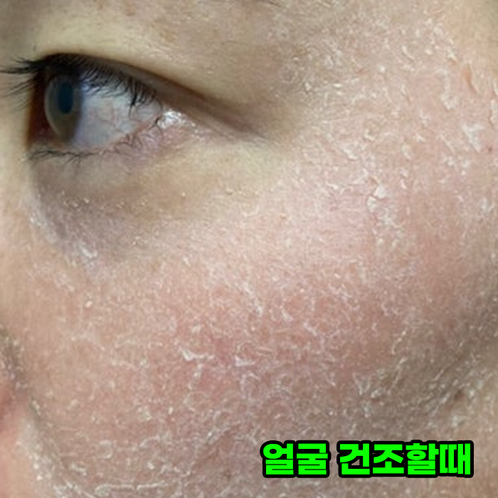 얼굴 건조할때 피부건조증 이거면 되네! 네이버