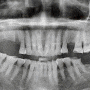 덕계임플란트 다수의 파절된 치아를 대체한 케이스
