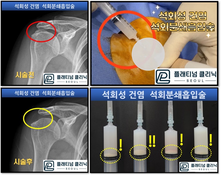 (플래티넘의원)어깨 석회성건염 수술없이 한번에 해결하는 방법!!