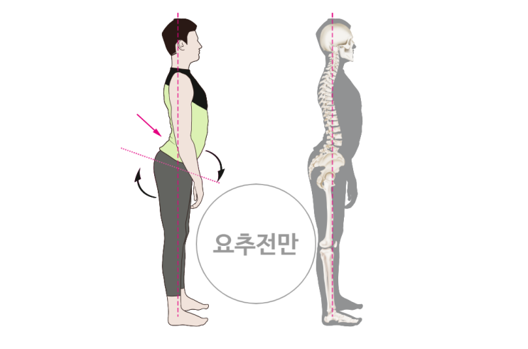 요추전만자세 요추전만증 원인과 증상 : 네이버 블로그