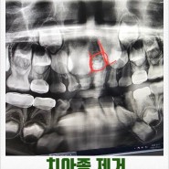 8세 치아종 제거수술 후기 1탄 치아종발견 및 입원수속
