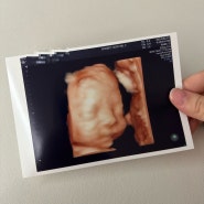 [임신] 안양 봄빛병원 입체초음파 후기