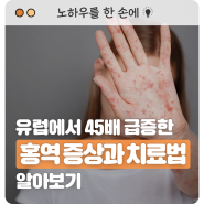 유럽에서 45배 급증한 ‘홍역 바이러스’ 증상과 치료법 알아보기 (Feat. 성인 홍역)