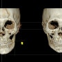 주걱턱이 동반된 심한 안면비대칭 양악수술