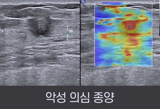 유방암인지 양성혹인지 알 수 있는 유방 초음파 방법 '횡파탄성초음파' : 네이버 블로그