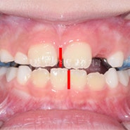[구리교정치과] 소아 반대교합을 동반한 치아중심선 비대칭, 교정치료를 통해 개선