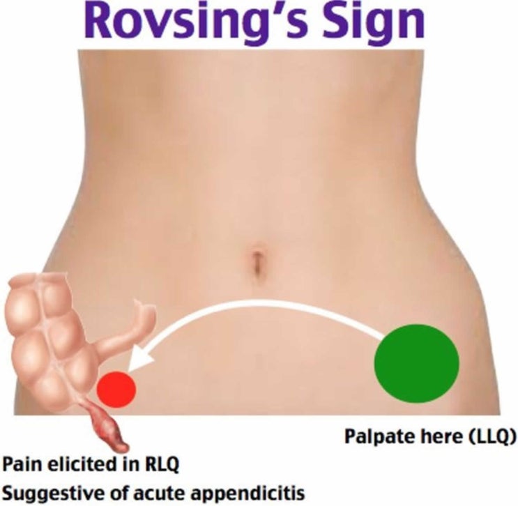 로브싱 징후 Rovsing's Sign : 네이버 블로그