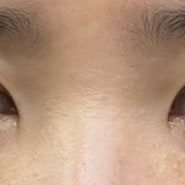 (11일~15일차) 30대 쌍수 붓기 변화, 얼굴 각질, 눈당김, 온찜질(자연유착+눈매교정+듀얼트임)