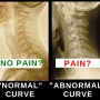 X-ray, MRI : 통증의 오해와 진실 (3편)