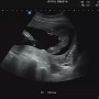 임신 15주차, 16주차, 17주차, 18주차 +주수별 자궁경부길이