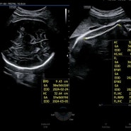 [임신일기] 37주 ~ 38주 / 두통 & 소화불량 / 38주 초음파 / 열달후에 기록 / 첫 내진 / 이미 자궁문 2cm 열려있음 / 모유수유 공부