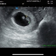 임신 7주차(24.02.03)검진 : 출산예정일 변경