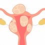 [복강경 자궁근종수술] 제거하기 쉬운 형태의 자궁근종
