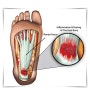 족저근막염 원인 양쪽 발바닥 통증 치료 방법