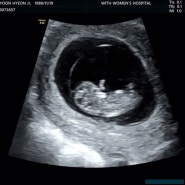 임신 9주차 증상 / 임신10주차 태아크기 특징, 임산부 체중조절, 적정몸무게 맞춤 증가표/ 공복유산소