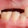 발치 후 보철치료를 미루면 안 되는 이유 / 치아의 정출과 이동 / 임플란트 공간 부족
