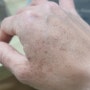 동남아 베트남여행후 손등기미 , 얼룩 , 화상 , 갈색반점증상 / 식물광선피부염