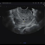 [시험관 기록] 동결1차 성공 / 임신 4주 6일 아기집 확인 / 골치아픈 갑상선 호르몬 수치