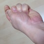 이유없는 손가락 저림과 통증 손목터널증후군 수근관증후군이 의심된다? 정확한 감별진단방법