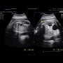[ 임신34주 ] 진주참조은산부인과 / 태아콩팥크기변화 / 태아수신증 / 경상대의뢰서