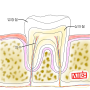 인덕원역 치과 치경부 마모란 무엇일까?- 원인과 증상, 해결 방법