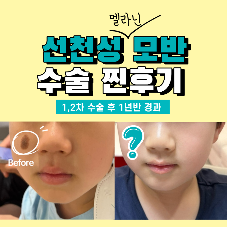 소아 선천성 멜라닌 모반 / 얼굴 큰점 제거 성형외과 수술 전후 비교 흉터관리 최종기록 후기 결과 : 네이버 블로그