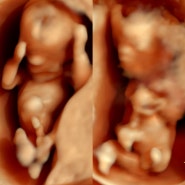 [임신 기록 9~12주] 이란성 쌍둥이 입덧+먹덧 첫 입체초음파 목투명대, 코뼈검사, 태몽 및 성별각도법(?)