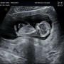 정신없이 흘러간 임신10주~11주 (베트남 다낭 셀드메르호텔,바나힐,기형아검사)