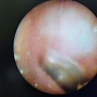 메니에르병의 청력 손상 정도를 나타내는 내림프수종