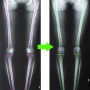 비수술 오다리교정 비골 돌출 무릎뼈 튀어나옴 치료전후 엑스레이 스캐노그램 비교 - 강남수재활의학과 휜다리클리닉