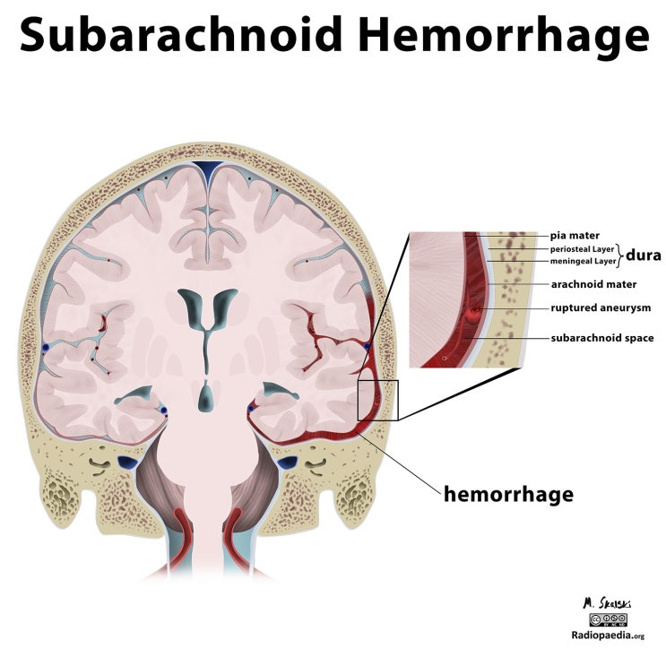 Brain Hemorrhage : 네이버 블로그