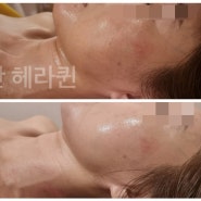 일산 마두동 피부관리 하이온 리프팅관리