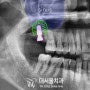 더서울이 sinus 골이식 잘한다는 소문의 진실 : 성남 치과 디지털 임플란트