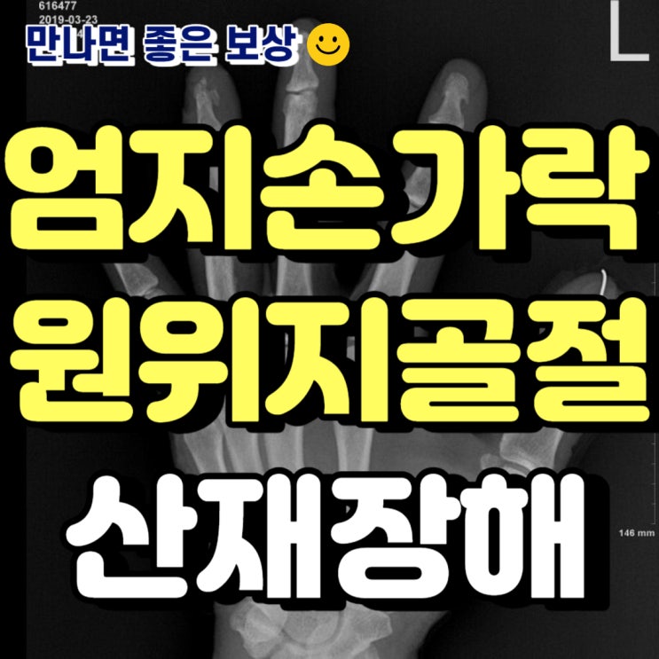 산재 엄지손가락 원위지골 개방성골절(s678,s6271) 관혈적정복술,창상봉합술 산재장해등급 : 네이버 블로그
