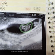 임신 5주 7주 8주 증상 (갑상선기능저하증, 입덧시작)
