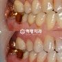 고척동 치과 에서 치경부 마모증 치료로 10분 만에 치아 패임과 이 시림 증상 해결!