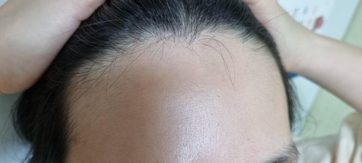 피부 요철 없애는 법? 알아볼게요 : 네이버 블로그