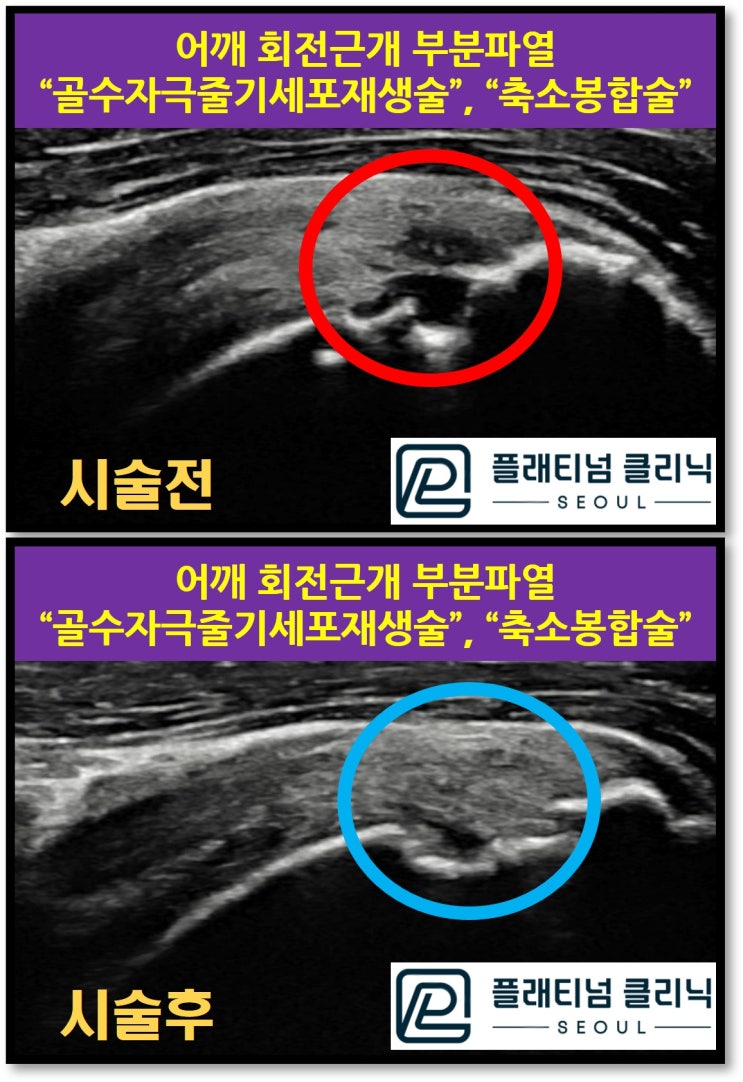 어깨 회전근개 부분파열은 신사역 강남 정형외과 플래티넘의원에서. 골수자극 줄기세포 재생술 및 축소봉합술로.