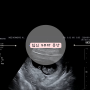 [임신9주차증상] 젤리곰보이는시기 초음파영상 9주3일아기심장소리 입덧약처방(디너지아장용정) 피부트러블 피고임