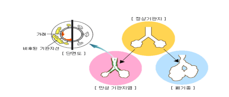 [Case review #1]COPD (만성폐쇄성폐질환), Hemoptysis (객혈) : 네이버 블로그
