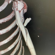 상완골 근위부-골간부 골절(Proximal-shaft humeral fracture)의 수술적 치료/ Proximal humeral Long Plate